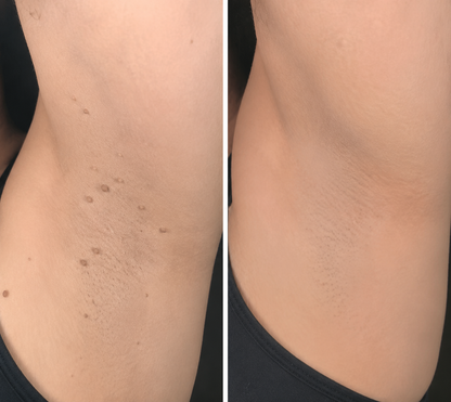 ✨2-in-1 Microneedle & Hydrocolloid Patch🍀| Removes Raised Moles, Acne, Flat Warts & Skin Tags | Helps Improve Wrinkles, Scars & Blemishes | Invisible Patches for Face & Body