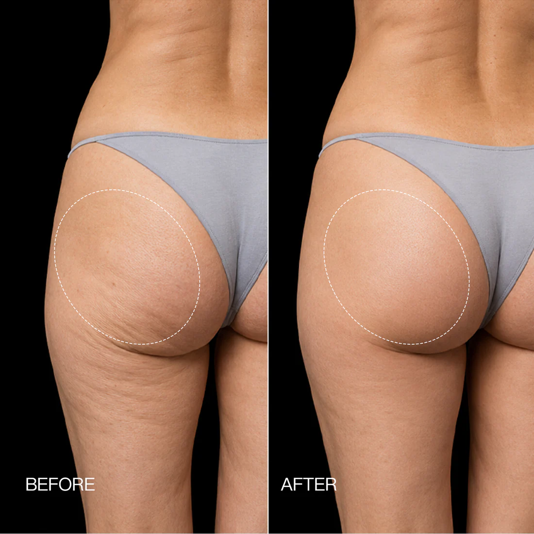 Neravio 3-Zone EMS Toning Shorts: Targeted Abdomen, Glutes & Pelvic Floor Support