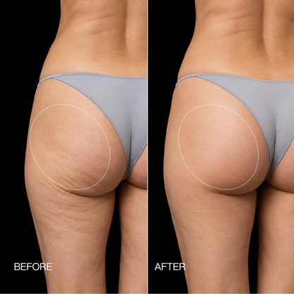 Neravio 3-Zone EMS Toning Shorts: Targeted Abdomen, Glutes & Pelvic Floor Support