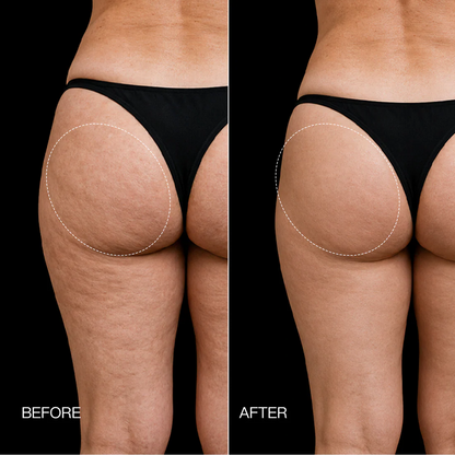 Neravio 3-Zone EMS Toning Shorts: Targeted Abdomen, Glutes & Pelvic Floor Support