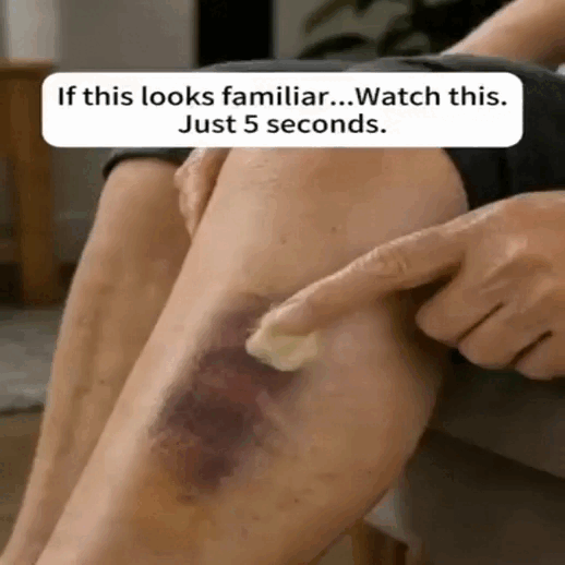 Bruise and fragile skin concern animation
